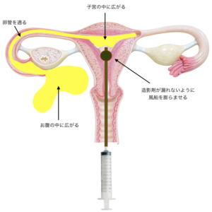 子宮卵管造影