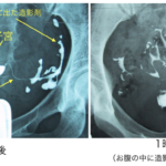 子宮卵管造影2