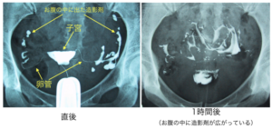 子宮卵管造影2