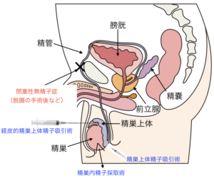 無精子症の治療