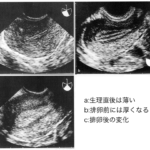 子宮内膜の超音波