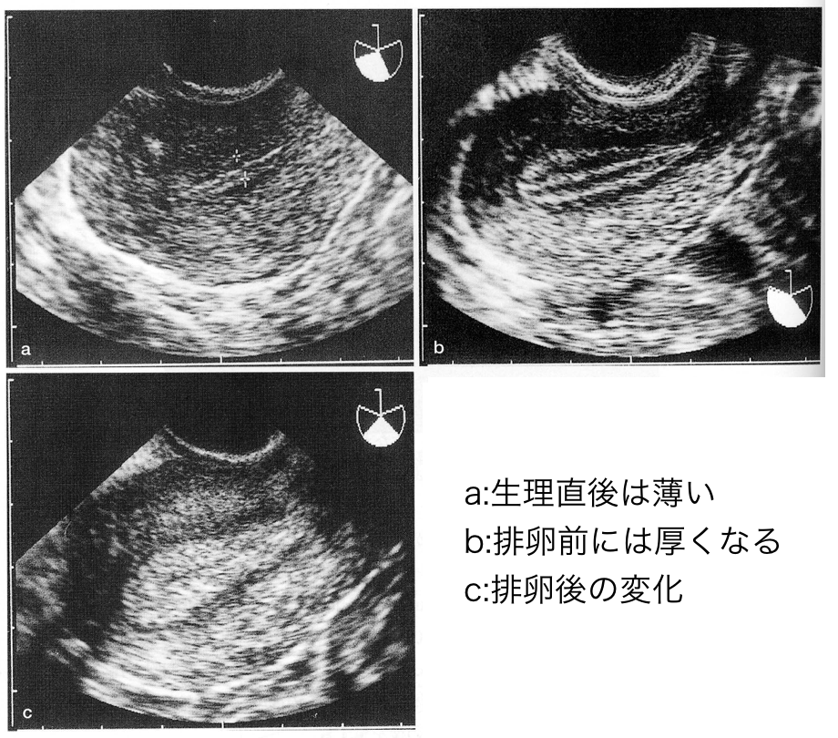 子宮内膜の超音波