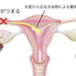 クラミジアによる不妊症