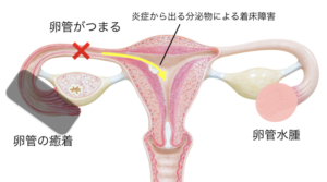 クラミジアによる不妊症