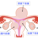 子宮筋腫の種類