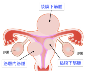 子宮筋腫の種類