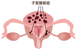 子宮腺筋症図