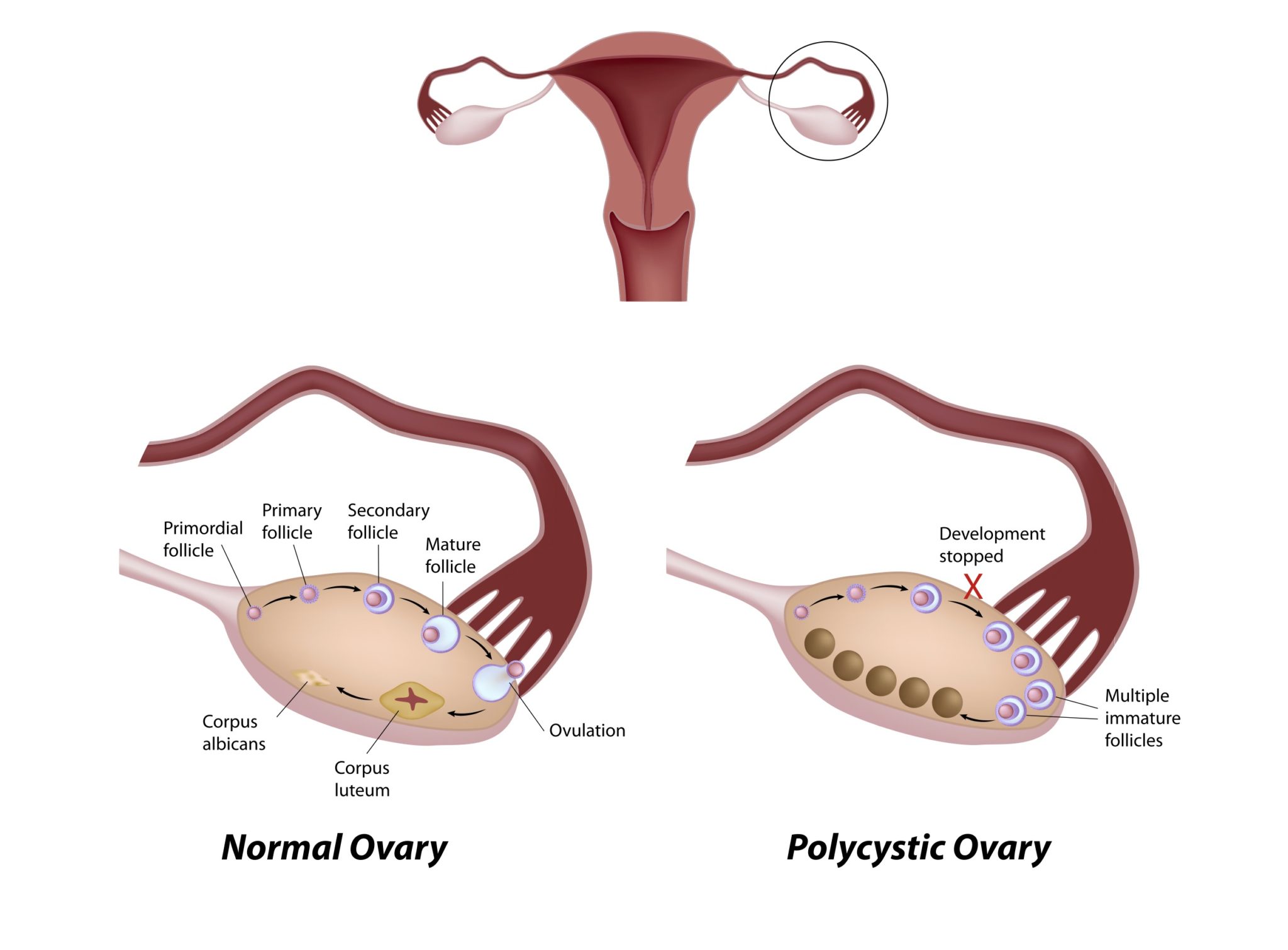 多 嚢胞 性 卵巣 症候群 流産 し やすい