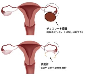 cystectomy