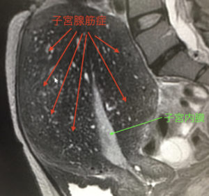 子宮腺筋症