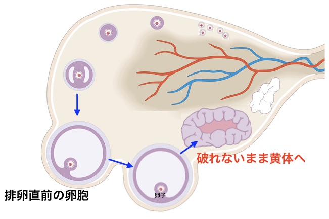 黄体 化 未 破裂 卵胞 妊娠 した ブログ