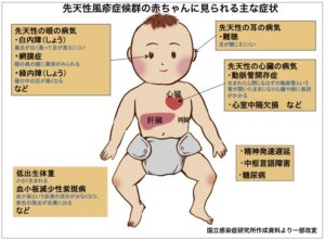 先天性風疹症候群の症状