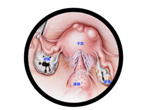 子宮内膜症