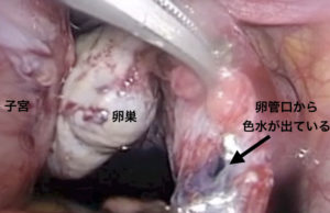 卵管色素検査